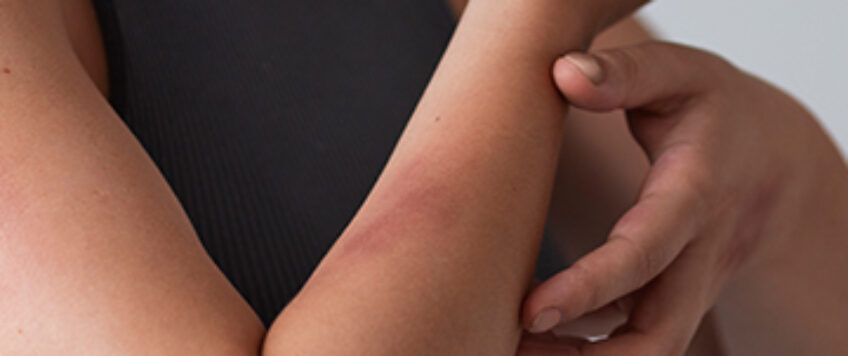 Psoriasis-Safe Claim